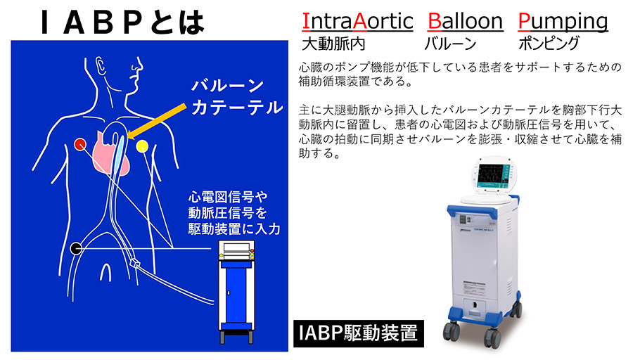 大動脈内バルーンポンピング（IABP）