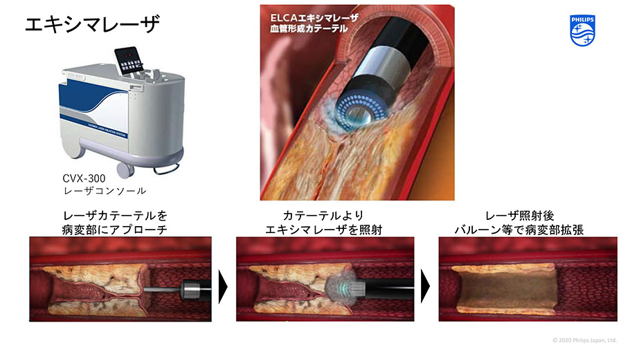 エキシマレーザー
