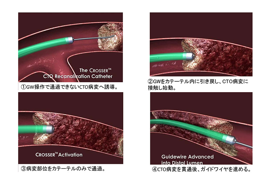 クロッサーシステム
