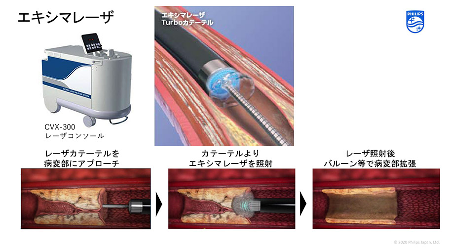 エキシマレーザー