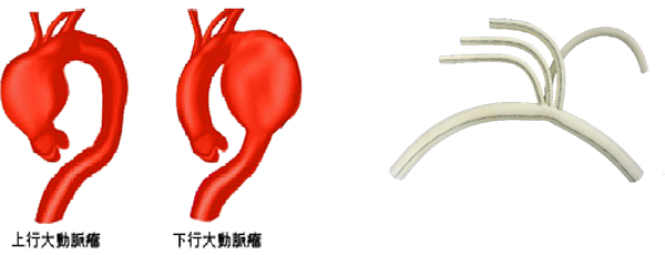 大動脈瘤
