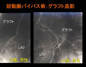 冠動脈バイパス②