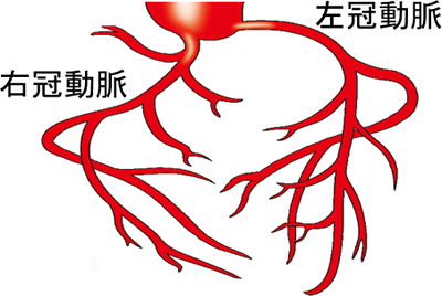 虚血性心疾患