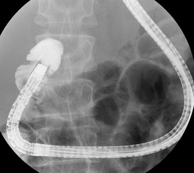 バルーン内視鏡を用いたERCP（DB-ERCP）