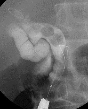 バルーン内視鏡を用いたERCP（DB-ERCP）