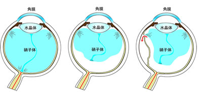 裂孔原性網膜剥離