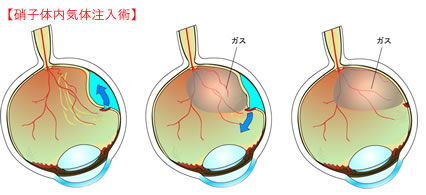 硝子体内気体注入術