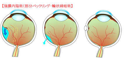 強膜内陥術（部分バックリング・輪状締結術）