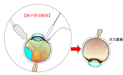 硝子体切除術