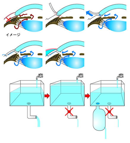 線維柱帯切除術