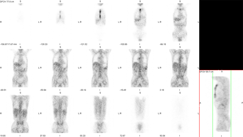 ガリウムシンチグラフィ全身画像とSPECT(断層)画像