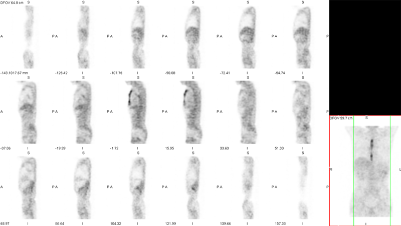 ガリウムシンチグラフィ全身画像とSPECT(断層)画像