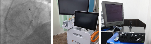 高速回転式アテレクトミーを使用した冠動脈形成術